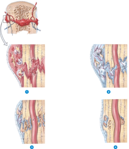 Briefly describe what is happening in each step of fracture repair shown in the diagram.