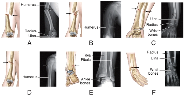 <strong>Which illustration and radiograph in the figure shows an impacted fracture where one end of the fractured bone is forcefully driven into the interior of the other end? </strong> A)A B)B C)C D)D E)E