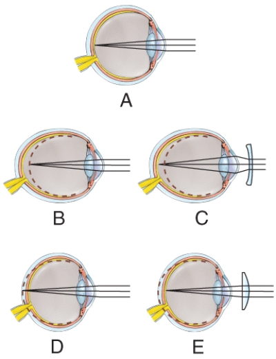 <strong>Which figure illustrates nearsightedness before it has been corrected? </strong> A)A B)B C)C D)D E)E
