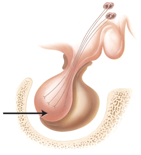<strong>Which of the following conditions could potentially result from hyposecretion of a hormone released by the portion of the marked gland in the diagram? </strong> A)tetany B)acromegaly C)diabetes insipidus D)goiter E)Cushing's syndrome