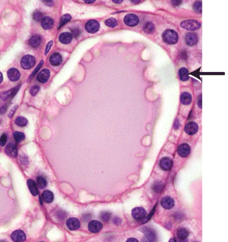 <strong>Which of the following hormones is produced by the cells marked in the thyroid follicle shown in the histology picture? </strong> A)calcitonin B)vasopressin C)triiodothyronine (T₃) D)antidiuretic hormone (ADH) E)calcitriol