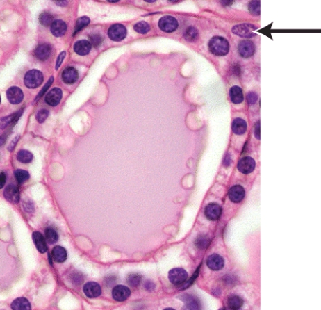 <strong>Which of the following hormones is produced by the cells marked in the thyroid follicle shown in the histology picture? </strong> A)calcitonin B)vasopressin C)triiodothyronine (T₃) D)antidiuretic hormone (ADH) E)calcitriol