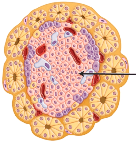 <strong>Which of the following diseases result when the cells marked in the histology image are destroyed by the immune system? </strong> A)Cushing's disease B)Addison's disease C)Acromegaly D)Type 1 diabetes E)Diabetes insipidus
