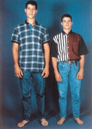 <strong>What endocrine abnormality does the individual on the left in the picture of identical twins have? </strong> A)Goiter B)Graves' Disease C)Type 2 diabetes D)Cushing's syndrome E)Gigantism