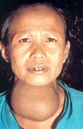 <strong>Which of the following endocrine disorders is the individual shown in this picture suffering from? </strong> A)Acromegaly B)Graves' Disease C)Goiter D)Cushing's syndrome E)Giantism