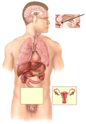 <strong>Hypersecretion of a hormone by the endocrine gland marked in the diagram results in a type of depression that affects some people during the winter months,when the day length is short,known as </strong> A)thyroid crisis (storm). B)general adaptation syndrome (GAS). C)seasonal affective disorder (SAD). D)Addisonian crisis. E)posttraumatic stress disorder (PTSD).