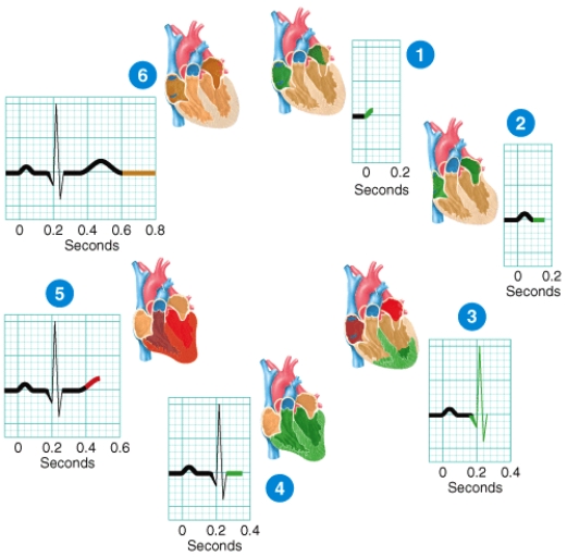 Briefly describe what is happening at stage of the ECG labeled 5 in the diagram.  <div style=padding-top: 35px> 
