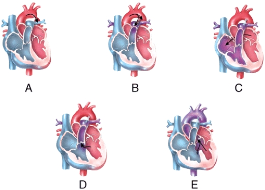 <strong>Which of the labeled diagrams shows coarctation of the aorta?  </strong> A)A B)B C)C D)D E)E <div style=padding-top: 35px> 