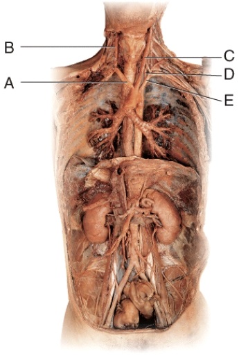 <strong>Which of these following vessels of the neck contributes directly to the formation of the basilar artery? </strong> A) A B) B C) C D) D