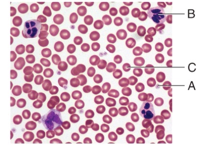<strong>Which cell is involved in the condition known as Polycythemia?  </strong> A) A B) B C) C D) None of these choices <div style=padding-top: 35px> 