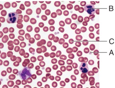 <strong>Which cell type is involved in the condition known as Leukemia?  </strong> A) A B) B C) C D) None of these choices <div style=padding-top: 35px> 