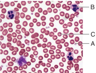<strong>Which cell type is involved in the condition known as Thrombocytopenia?  </strong> A) A B) B C) C D) None of these choices <div style=padding-top: 35px> 
