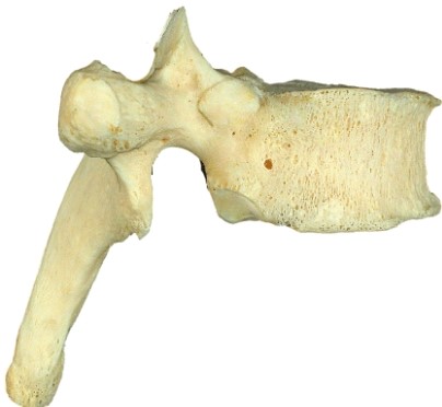 <strong>What type of vertebra is shown in here? </strong> A) cervical B) thoracic C) lumbar D) sacral