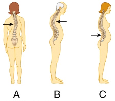 <strong>Which of the following exhibits an abnormal kyphotic curvature of the spine? </strong> A) A B) B C) C