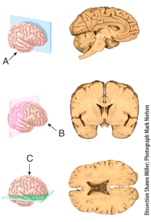 <strong>The section shown in (b)results from cutting through a _______ plane extending through the brain? </strong> A)frontal B)sagittal C)oblique D)midsagittal E)transverse