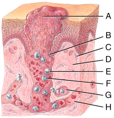 <strong>Which of the labeled cells in the diagram of deep wound healing shown below has phagocytic properties? </strong> A)C B)E C)F D)All of these answer choices are correct. E)Both E and F