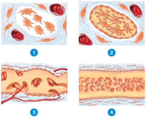 Briefly describe what is happening in each of the numbered stages of intramembranous ossification as observed in a child's skull shown in the diagram below.