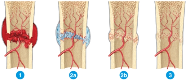 Briefly describe what is happening in each step of fracture repair shown in the diagram.