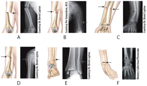 <strong>Which illustration and radiograph in the figure shows a Pott's fracture? </strong> A)A B)B C)C D)D E)E