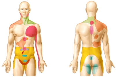 <strong>What do colored regions on body's surface in the diagram represent? </strong> A)Dermatomes B)Areas of referred pain C)Regions of nociceptors D)Areas supplied by the primary somatosensory area E)Motor nuclei