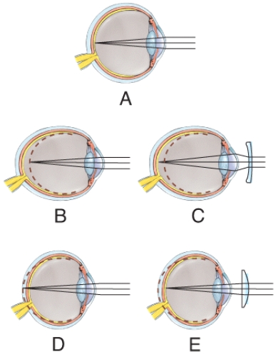 <strong>Which figure illustrates farsightedness before it has been corrected? </strong> A)A B)B C)C D)D E)E
