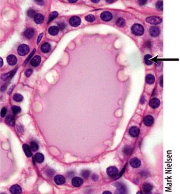 <strong>Which of the following hormones is produced by the cells marked in the thyroid follicle shown in the histology picture? </strong> A)calcitonin B)vasopressin C)triiodothyronine (T<sub>3</sub>) D)antidiuretic hormone (ADH) E)calcitriol