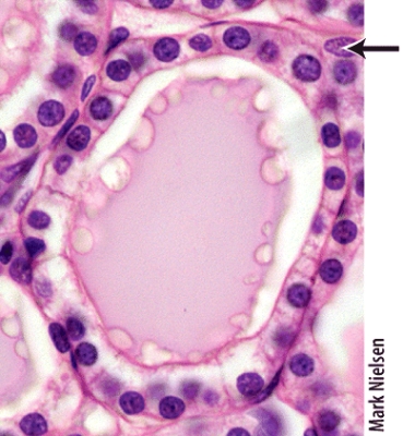 <strong>Which of the following hormones is produced by the cells marked in the thyroid follicle shown in the histology picture? </strong> A)calcitonin B)vasopressin C)triiodothyronine (T<sub>3</sub>) D)antidiuretic hormone (ADH) E)calcitriol