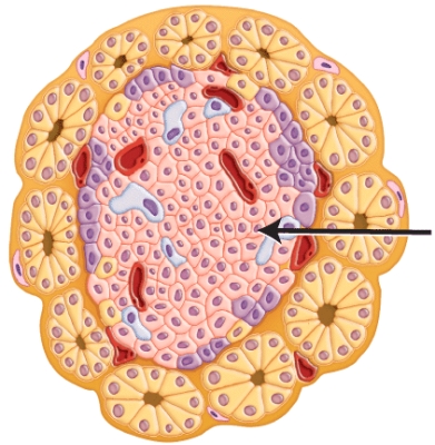 <strong>Which of the following diseases result when the cells marked in the histology image are destroyed by the immune system? </strong> A)Cushing's disease B)Addison's disease C)Acromegaly D)Type 1 diabetes E)Diabetes insipidus