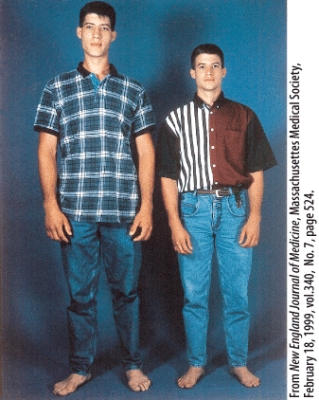 <strong>The disorder shown in one of the identical twins seen in this figure is due to a hypersecretion of hormones by which endocrine gland? </strong> A)Thyroid gland B)Pineal gland C)Parathyroid gland D)Pituitary gland E)Pancreas