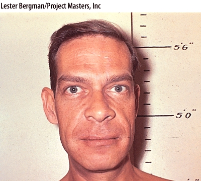 <strong>The patient shown is suffering from a disease called _____,caused by a pituitary hypersecretion of hGH during adulthood. </strong> A)Goiter B)Graves' Disease C)Acromegaly D)Cushing's syndrome E)Giantism