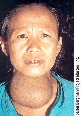 <strong>Which of the following endocrine disorders is the individual shown in this picture suffering from? </strong> A)Acromegaly B)Graves' Disease C)Goiter D)Cushing's syndrome E)Giantism