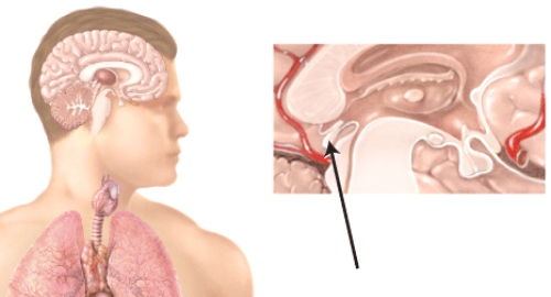 <strong>Hypersecretion of a hormone by the endocrine gland marked in the diagram results in a type of depression that affects some people during the winter months,when the day length is short,known as </strong> A)thyroid crisis (storm). B)general adaptation syndrome (GAS). C)seasonal affective disorder (SAD). D)Addisonian crisis. E)posttraumatic stress disorder (PTSD).