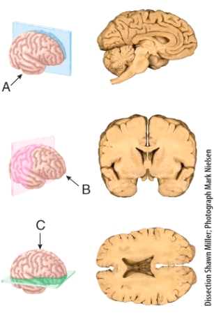 <strong>The section shown in (B)results from cutting through a _______ plane extending through the brain? </strong> A)frontal B)sagittal C)oblique D)midsagittal E)transverse