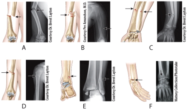 <strong>Which illustration and radiograph in the figure shows a Pott's fracture? </strong> A)A B)B C)C D)D E)E