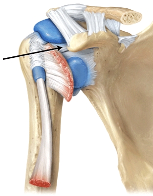 The function of the ligament the line is pointing to is a)strengthens superior part of the articular capsule b)joint stabilization when present c)secures the long head of the biceps brachii d)helps enlarge the glenoid cavity