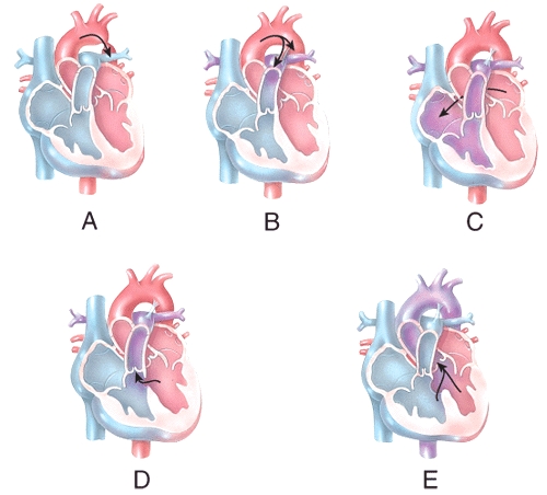 <strong>Which of the labeled diagrams shows an atrial septal defect?  </strong> A)A B)B C)C D)D E)E <div style=padding-top: 35px> 