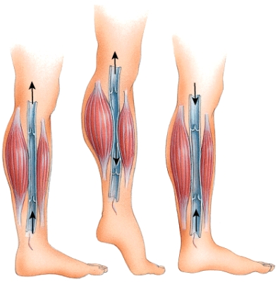 <strong>What physiological process is depicted in this figure? </strong> A)Venous blood blockage B)Skeletal muscle pump C)Respiratory pump D)Thoroughfare channels E)Anastomosis