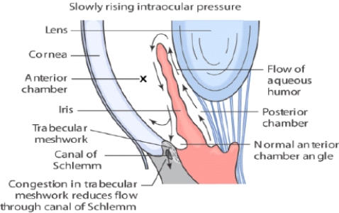   The X marks the area of the eye where glaucoma causes fluid to accumulate.Acute angle-closure and open-angle glaucoma are caused when the balance between intraocular fluid production and drainage is disrupted,resulting in increased intraocular pressure.