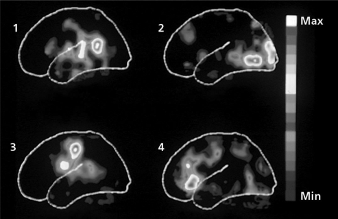 Which of the PET images above shows high levels of activity in the occipital lobe?