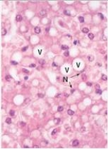 <strong>The structure designated by the V in the accompanying photomicrograph of liver is formed by which one of the following pathophysiologic mechanisms? </strong> A)Apoptosis B)Dilation of endoplasmic reticulum C)Hydropic change D)Impaired metabolism of fatty acids E)Necrosis