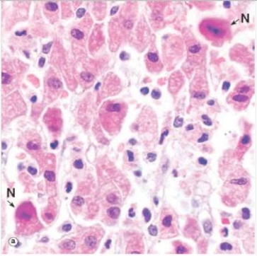 <strong>The nuclei in the liver cells designated with an N in the accompanying photomicrograph appear abnormal.Which one of the following terms best describes their appearance? </strong> A)Acidophilic B)Eosinophilic C)Vacuolated D)Karyolytic E)Pyknotic