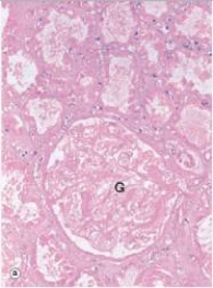 <strong>A renal glomerulus (G)and surrounding tubules are shown in the accompanying photomicrograph.Which one of the following is the best description of the histopathology seen? </strong> A)Absence of nuclei B)Acute inflammation C)Caseation necrosis D)Dissolution of underlying organ structure E)Pyknosis