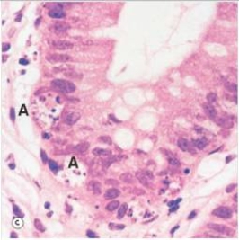 <strong>The structure labelled A in the accompanying photomicrograph of colonic mucosa represents which one of the following processes? </strong> A)Apoptosis B)Metaplasia C)Mitosis D)Necrosis E)Neoplasia