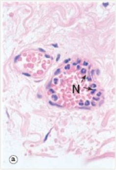 <strong>The neutrophils (N)in the accompanying photomicrograph are arranged at the peripheral wall of the blood vessel shown.Which one of the following is correct regarding their orientation in relation to the blood vessel? </strong> A)Extravascular B)Marginated C)Mid-axial D)Neutrophils should not be present in peripheral blood E)Normal