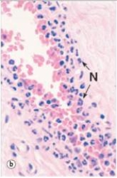 <strong>The neutrophils (N)in the accompanying photomicrograph are attracted to their extravascular location primarily by which one of the following factors? </strong> A)C3a B)C5a C)C5b D)Collagen E)Fibrin F)Neutrophil chemotactic factor