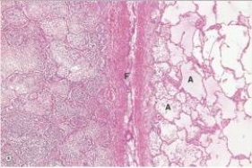 <strong>In the accompanying low power photomicrograph of lung,the interlobar fissure,labelled F,conveniently divides the lung in half.The end result of the pathologic process seen on the left- hand side,if properly treated with appropriate antimicrobials,would normally be which one of the following? </strong> A)Complete resolution B)Dysplasia C)Neoplastic change D)Pulmonary oedema E)Scarring