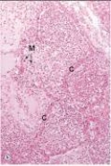<strong>In the accompanying high power photomicrograph of lung,the alveolar capillary is marked C.Which one of the following best describes its appearance in this instance? </strong> A)Clotted B)Congested C)Necrotic D)Oedematous E)Ruptured