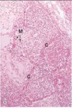<strong>In the accompanying high power photomicrograph of lung,the alveoli shown are filled primarily with which one of the following cells? </strong> A)Lymphocytes B)Neutrophils C)Eosinophils D)Macrophages E)Platelets