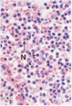 <strong>From analysis of the accompanying high power photomicrograph,how would you classify the acute inflammatory exudates seen? </strong> A)Eosinophilic B)Fibrinous C)Fibrous D)Granulomatous E)Purulent