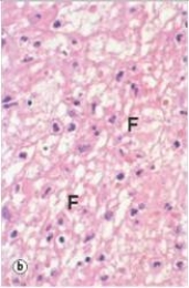 <strong>From analysis of the accompanying high power photograph,how would you classify the acute inflammatory exudates seen? </strong> A)Eosinophilic B)Fibrinous C)Fibrous D)Granulomatous E)Purulent